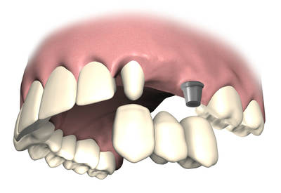 Hybridbrücke auf Zahn und Implantata
