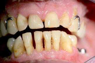 Parodontose Zahnverlust