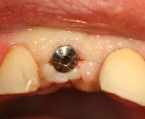 Bild 1: Einbringen des Zahnfleischformers und Bild 2: Gingivaformer eingesetzt
