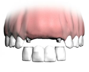 Implantatbrücke: festsitzender Zahnersatz