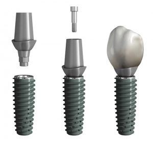 Implantatkrone: festsitzend