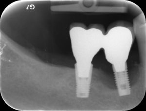 Knochenabbau um ein Implantat vermindert die Implantatstabilität