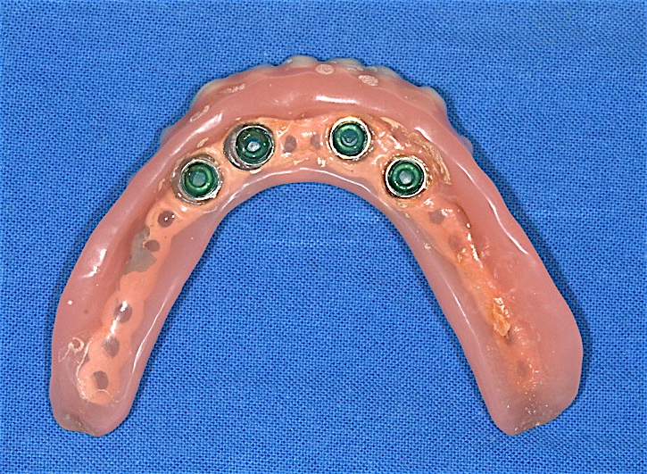 Locatorprothese von unten