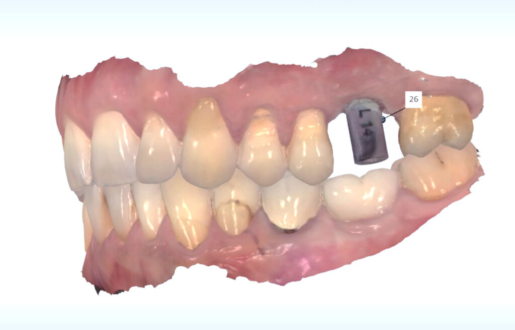 Scanabutment Implantatposition
