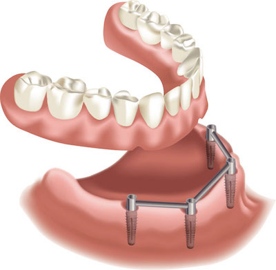 Overdenture Stegprothese