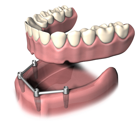 Verblockte Implantate sofort belastbar