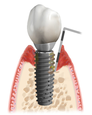 Peri-Implantitis