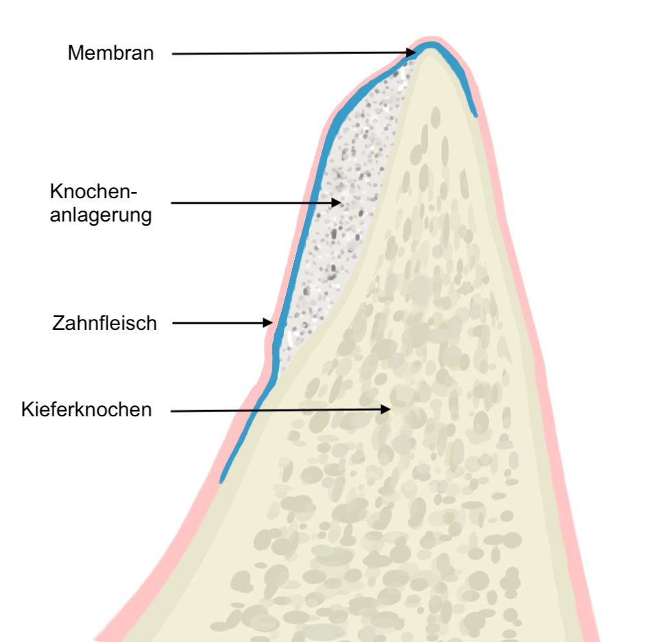 Knochenaufbau für Zahnimplantate