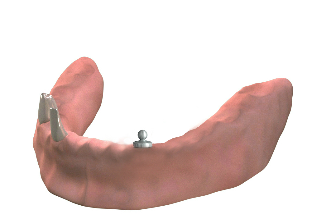 Pfeilervermehrung durch Kugelankerimplantat