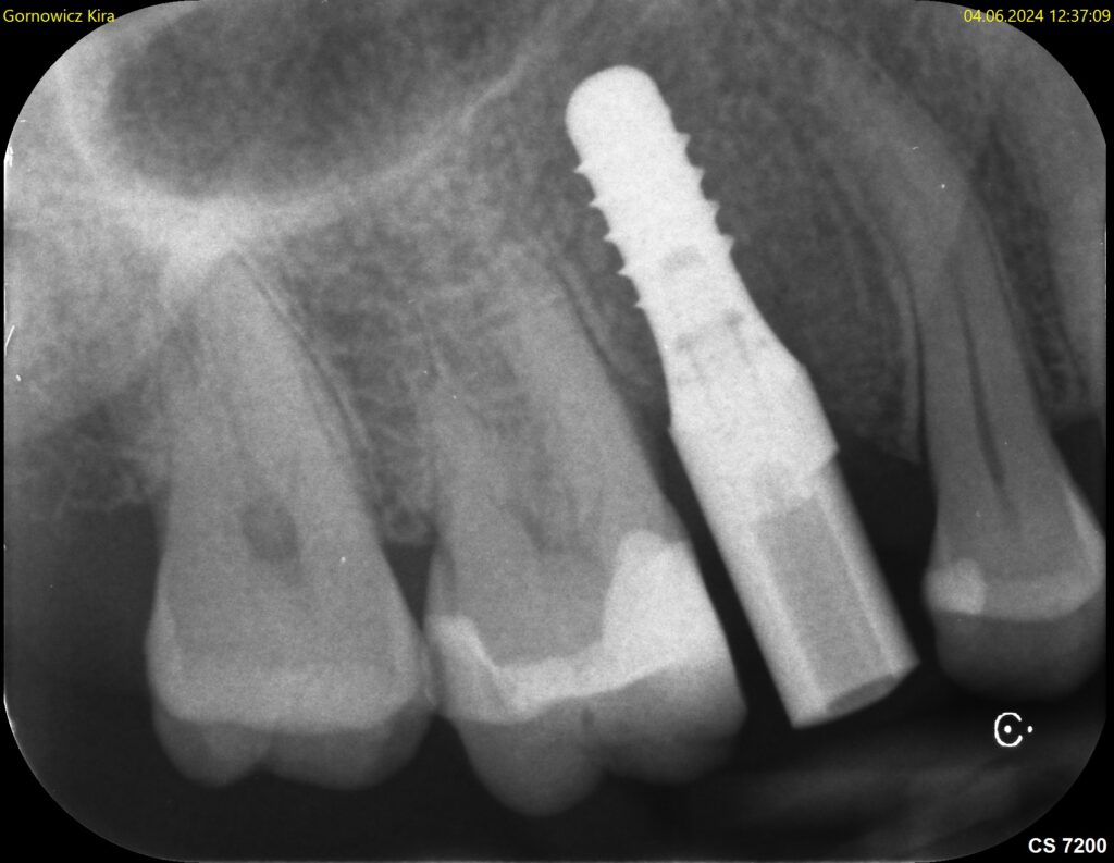 Scanabutment korrekt im Implantat -Röntgenbild