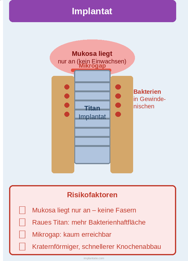 Biofilm auf Implantatoberfläche – Risiko für Periimplantitis
