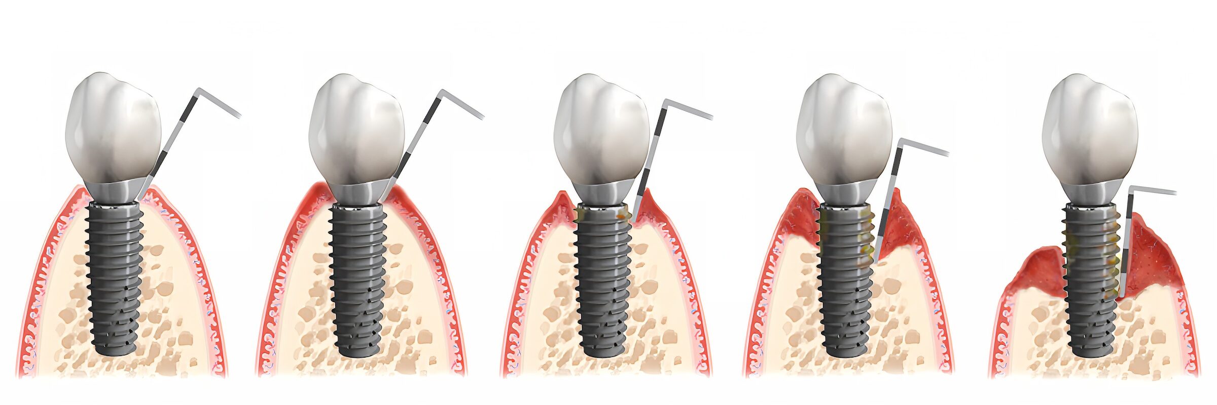 Periimplantitis – Von der gesunden Schleimhaut zur fortgeschrittenen Entzündung